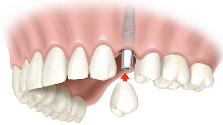 имплантация зубов немедленная нагрузка