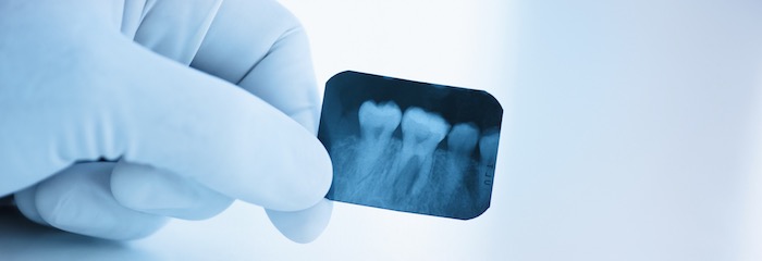 Прицельный снимок зуба