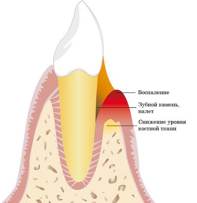 пародонтит зуба лечение