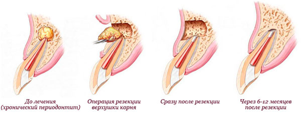 резекция верхушки корня зуба