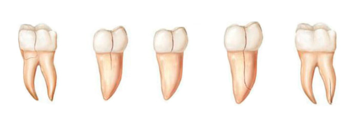 восстановление скола зуба